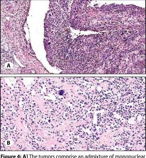 Figure From Primary Diffuse Type Tenosynovial Giant Cell Tumor Of The