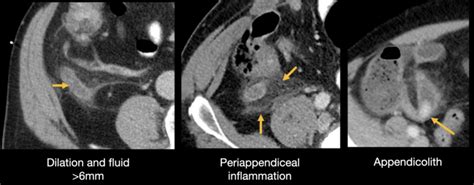 Abdominal CT: appendicitis • LITFL • Radiology Library