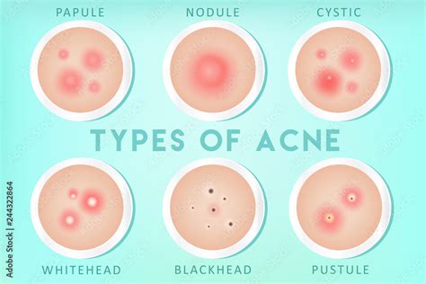 Acne Nodule Vs Cyst