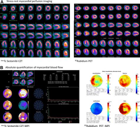 Radionuclide Tracers For Myocardial Perfusion Imaging And Blood Flow