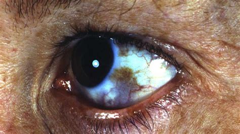 Blue Nevus Eyelid