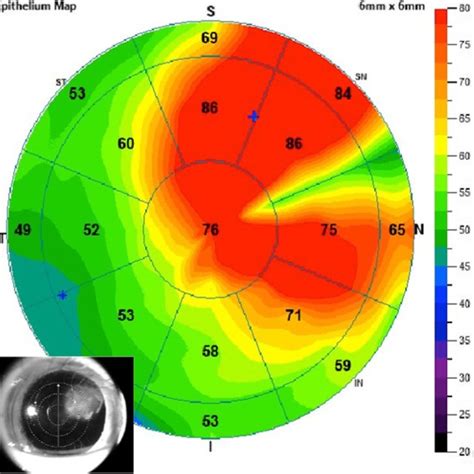 Epithelial Map Measured Via Anterior Hr Oct Normal Epithelial