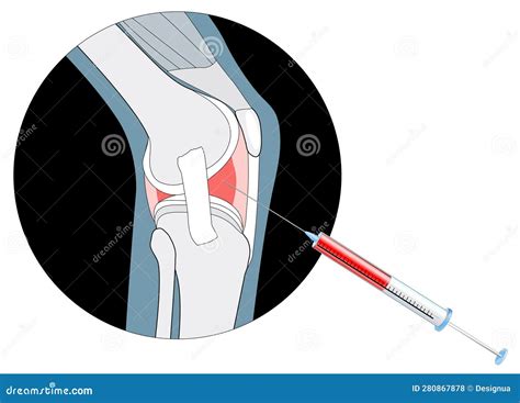 Injection Into The Painful Joint Stock Vector Illustration Of