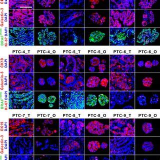 Immunofluorescence Staining Of CK19 Galectin 3 BRAFV600E And Ki 67