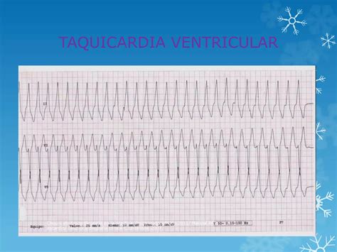 Trastornos Del Ritmo Card Aco Ppt