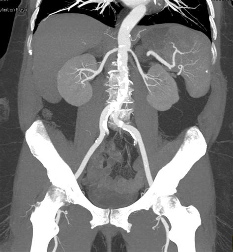 2cm Renal Cell Carcinoma Right Kidney Kidney Case Studies Ctisus Ct