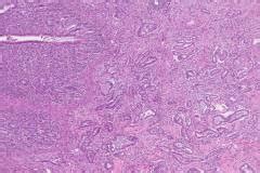 Ductal adenocarcinoma of the pancreas | Ottawa Atlas of Pathology