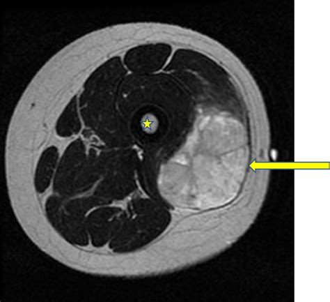 soft tissue sarcomas