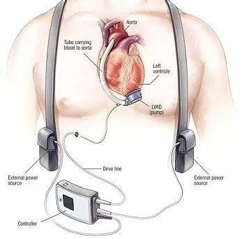 LVAD Surgery Cost in India - Left Ventricular Assist Device Surgery ...