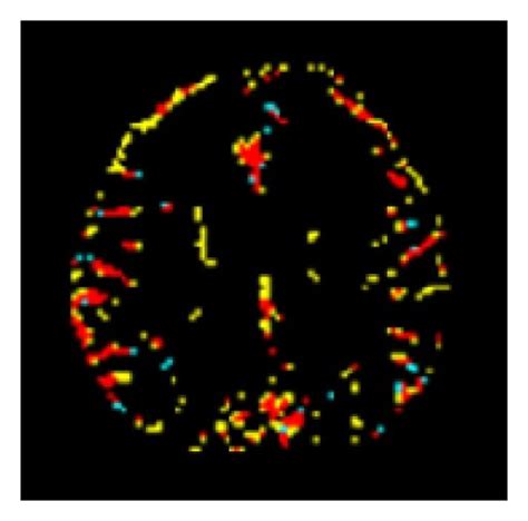 Representative images of the segmented normal brain parenchyma ((a ...