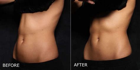 Coolsculpting Before After Photos In Kelowna Bc Dermmedica