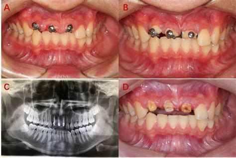 Orthodontic Extrusion With Crown Restoration In The Management Of Anterior Teeth Crown Root