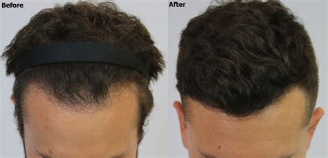 Diffuse Thinning Hair Restoration Result Alvi Armani Hair