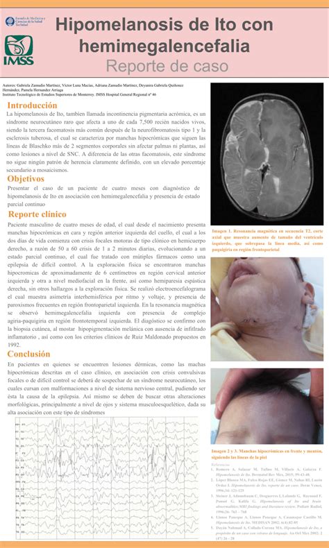 PDF Hipomelanosis De Ito Con Hemimegalencefalia Reporte De Caso