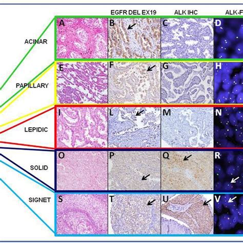 Study Profile Nsclc Non Small Cell Lung Cancer Adcadenocarcinoma