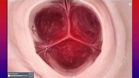 Estenosis Insuficiencia Aortica Y Pulmonar Pptx