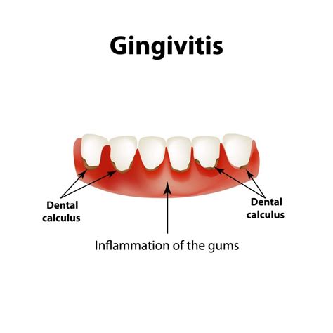 Reasons Why Your Gums Are Bleeding West Palm Beach Dentist