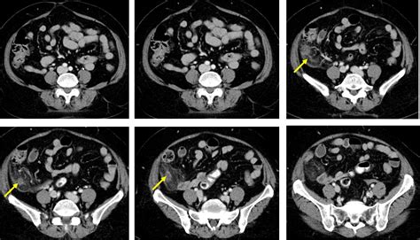 Acute appendicitis: transverse retrocaecal appendix – Radiology Cases