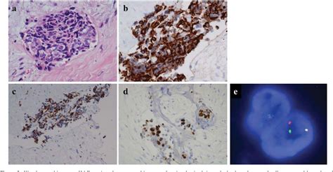 Figure 3 From Desmoplastic Small Round Cell Tumour Successfully Treated