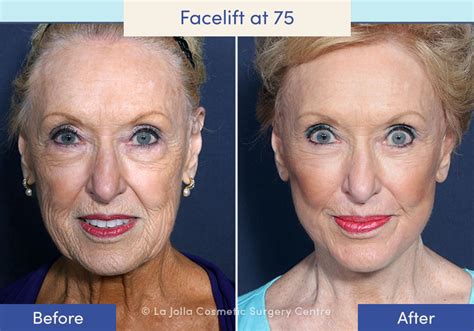 Facelift Before & After Photos: What a Facelift Looks Like at 40, 50 ...