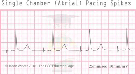 Ecg Educator Blog Pacemakers