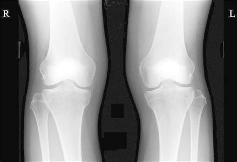 Medial And Lateral Femoral Condyles