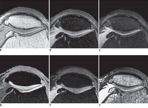 Evaluation of the Chondromalacia Patella Using a Microscopy Coil ...