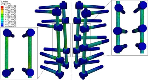 Von Mises Stress Distribution On The Posterior Rods And Artificial Download Scientific Diagram