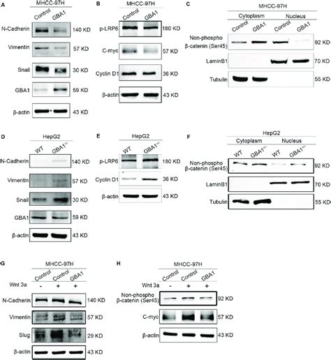 Low Expression Of GBA1 Promotes The Epithelial Mesenchymal Transition