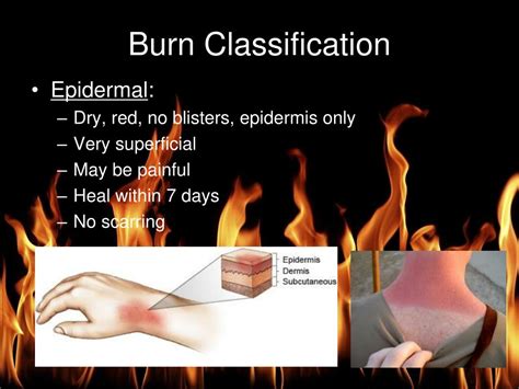 Ppt Burn Management Powerpoint Presentation Free Download Id5910760