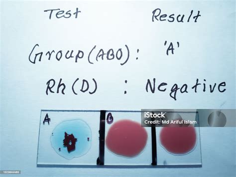 Exame Grupo Sanguíneo E Fator Rh - Foto de Teste De Grupo Sanguíneo E Fator Rh Por Método De Aglutinação ...