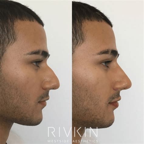 Non Surgical Rhinoplasty Los Angeles Non Invasive Cosmetic Surgery