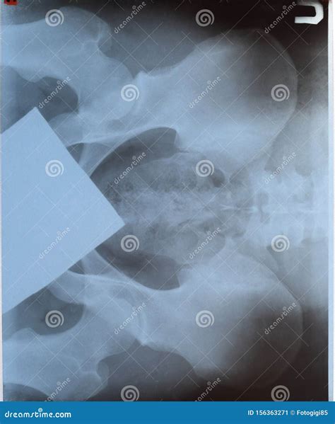 X-ray of the and Sacrum. X-ray Stock Image - Image of crest, arthritis ...