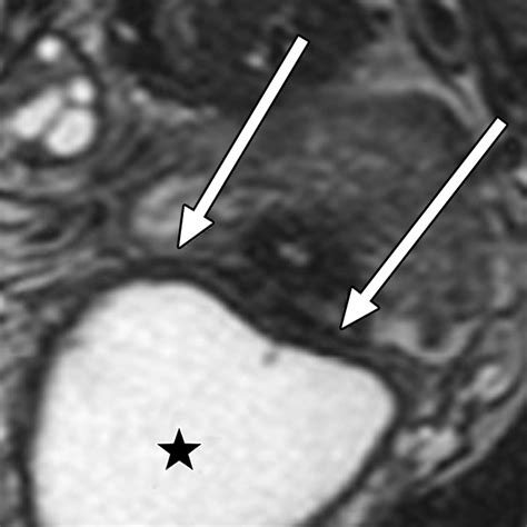 Anatomic Distribution Of Posterior Deeply Infiltrating Endometriosis On Mri After Vaginal And