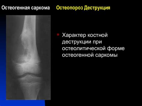 Рентгенодиагностика остеогенной саркомы — презентация