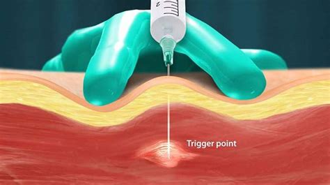 Trigger Point Injections Explained Novus Spine And Pain Center