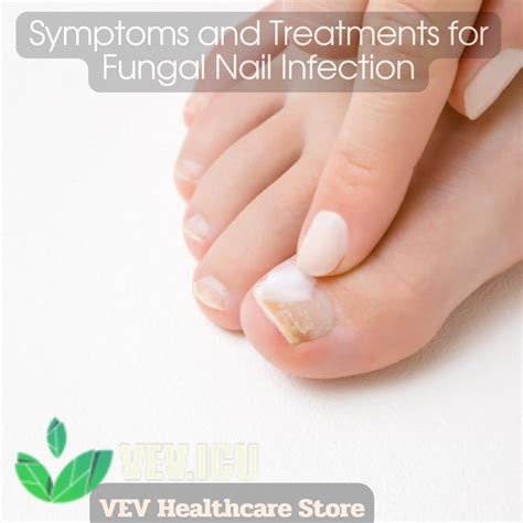 Symptoms And Treatments For Fungal Nail Infection