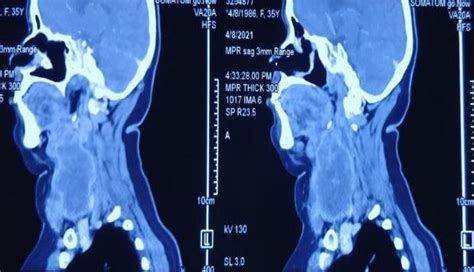 Contrast Ct Of Neck Showing Cranio Caudal Extent Of The Neck Mass Download Scientific Diagram