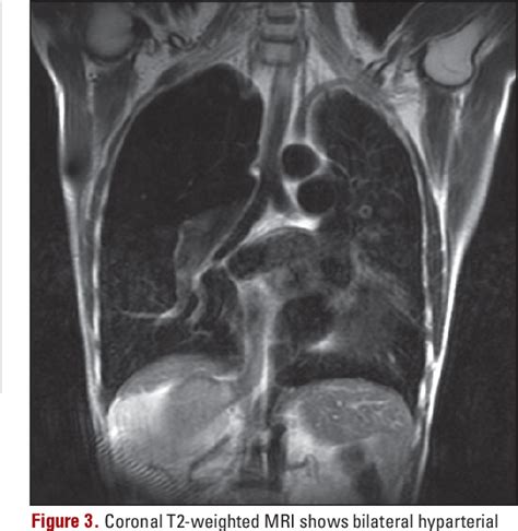 Figure 3 From Congenital Lobar Emphysema Associated With Polysplenia