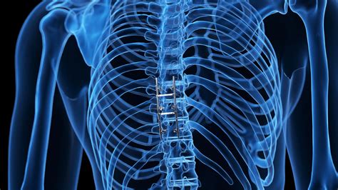 Spine Implants Devices Croom Medical