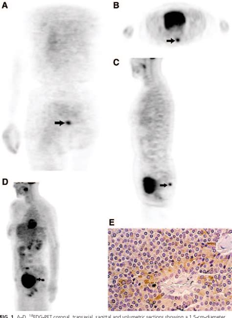 Figure From Corticotrophin Dependent Cushing Syndrome Due To