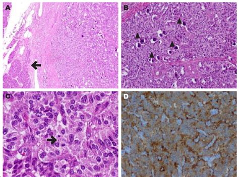 Neuroendocrine Tumor Of The Pancreas Pathology Specimen A At Low