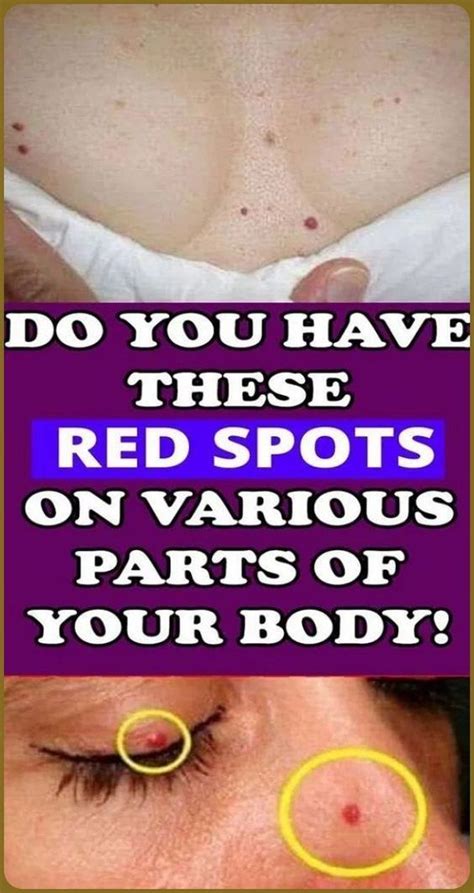 Do You Have These Red Spots On Various Parts Of Your Body Should You