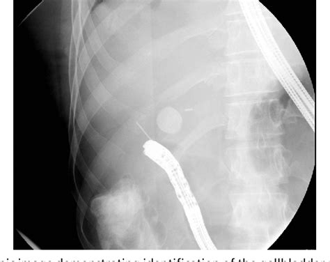 Figure 1 From Endoscopic Ultrasound Guided Gallbladder Drainage