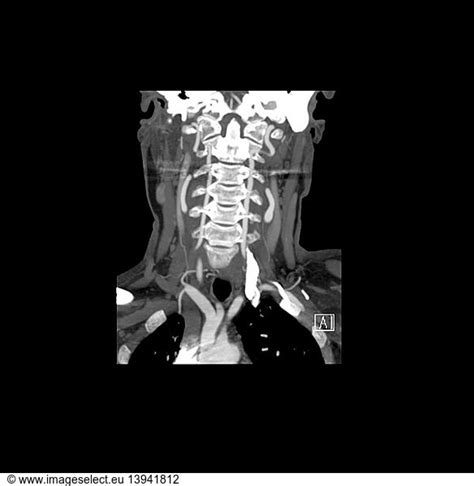 Cta Of Neck Vertebral Arteries Cta Of Neck Vertebral Arteries