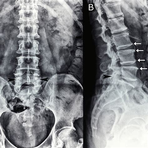 Lumbar Spine Radiographs Anteroposterior A And Lateral B Download Scientific Diagram