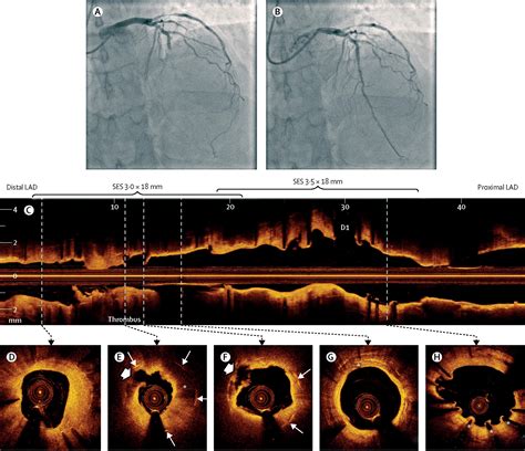 Intravascular Imaging In Coronary Artery Disease The Lancet