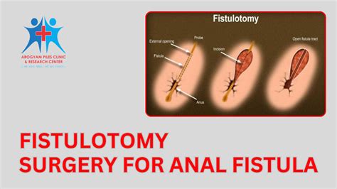 Fistulotomy Surgery For Anal Fistula Benefits And Drawbacks