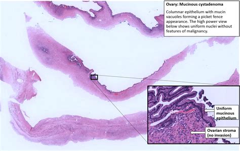 Ovary Mucinous Cystadenoma Nus Pathweb Nus Pathweb