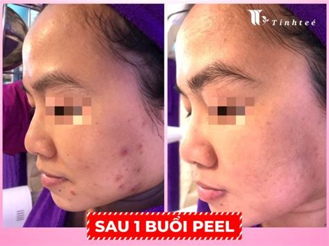 MỤn TrỨng CÁ NguyÊn NhÂn VÀ CÁch ĐiỀu TrỊ HiỆu QuẢ Tinh Tế Beauty